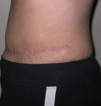 On my left hip, the skin bulges out a little over the tighter scar skin. At end of the scar line, the skin forms a little chunk of extra skin, like a sewing pattern that doesn't quite lay flat.