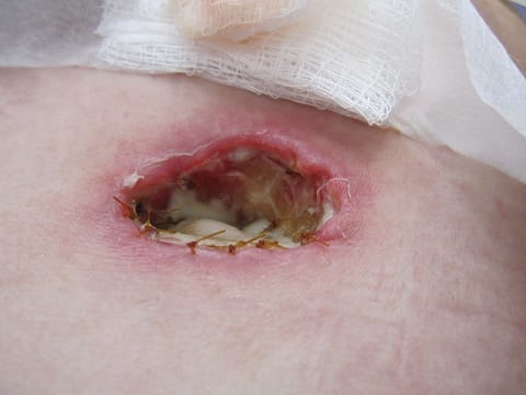 My belly button didn't want to take shape correctly. This was taken nearly two weeks after my surgery, and the hole continued spreading.