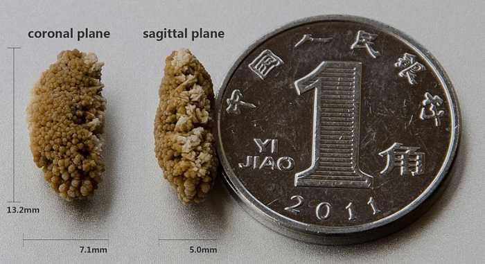 Kidney stones are small, but so is the ducts in your urinary tract. The jagged edges can scrape the walls and cause a great deal of pain as the stone is passed.