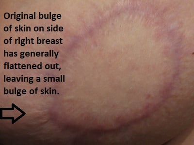 My right breast is a little larger than the left one, and it still has an extra chunk of skin that sticks out a little on the outside bottom edge. There's still a chunk of hardness remaining inside this breast.