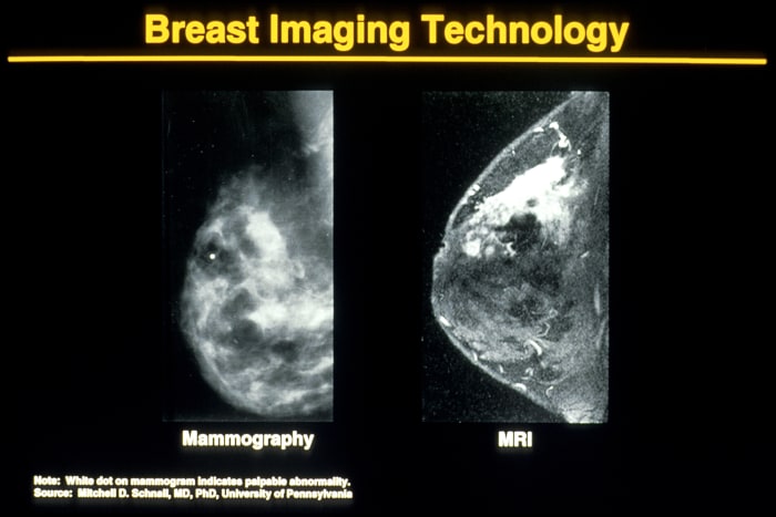 A mammography on left and a Magnetic resonance image (MRI) on right. Breast imaging technology has changed over the years. Note MRI's enhancement ability to confirm diagnosis.