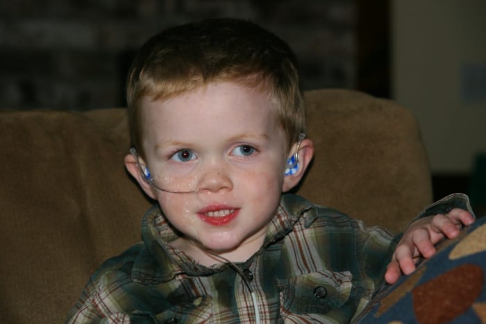 A pH probe may be performed if laryngomalacia is complicated by acid reflux. This involves a small pH-detecting probe inserted through the nose, which is worn for 24 hours.