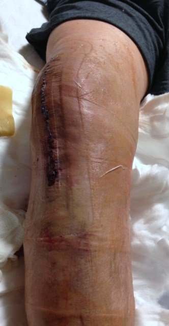This photo isn't for the faint at heart, but I thought the incision was so precise and impressive that I had to share. This was taken 36 hours after surgery, when the dressing was removed and replaced with another Aquacel covering.