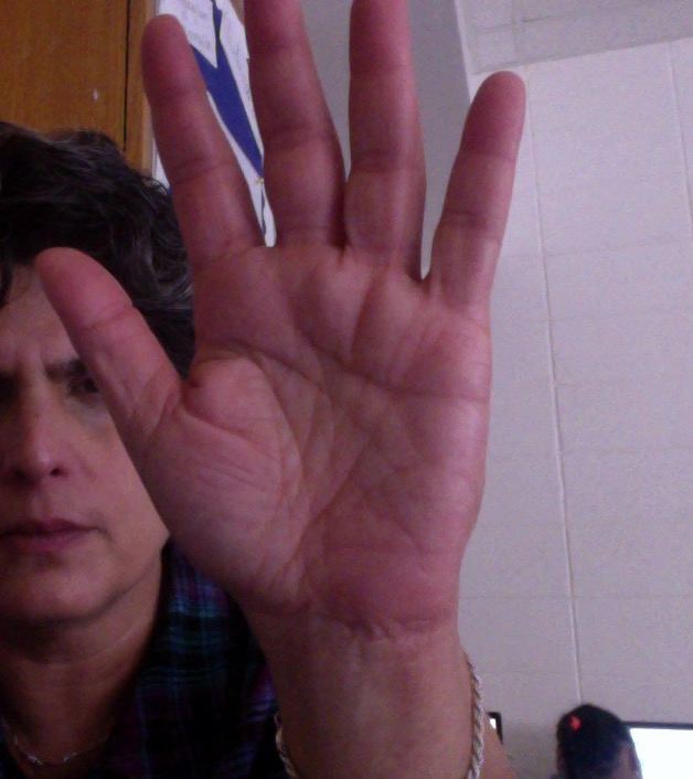 My most recent CTS surgery on my left hand. No more numbness and tingling, no scars, and full range of motion.
