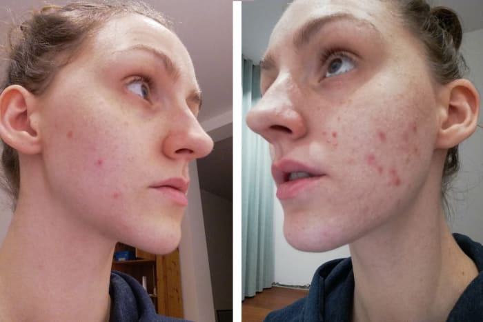 If a picker focuses on one area to pick, you'll see an asymmetry in skin marks. This can be another sign to look out for. This picture is the left and right side is me after a week of increased skin picking, you can clearly see my picking area.