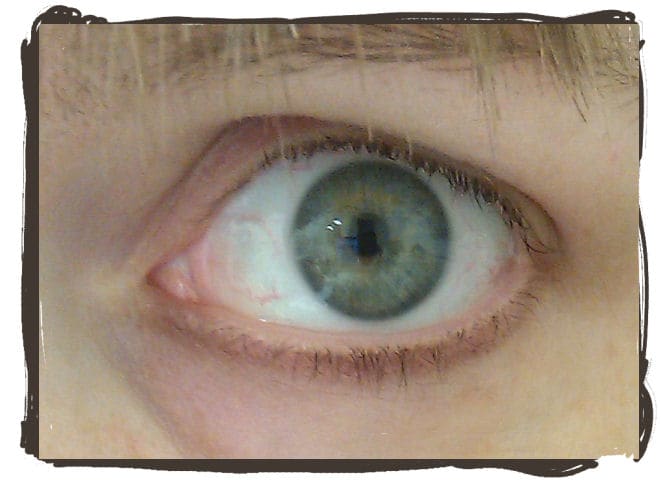 A little bit of red in the eye is normal. This is how my eye looks normally, and after completely healing.
