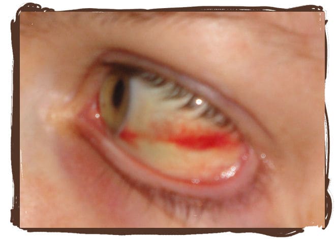 Day 3: The red has spread further towards the iris, while the rest continued to heal and showing less red in the outer part of the white.