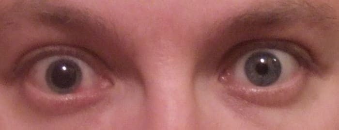 For the next 10 days I would live with one dilated eye. Not really comfortable, but necessary for best results.