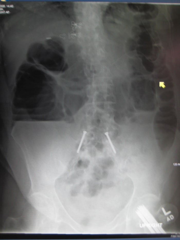 An obstruction of the large intestine.