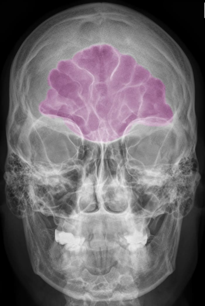 My mucocele was located in the far end of the frontal sinus over the end of my eyebrow. It was a very difficult area for the ENT Surgeon to reach with an endoscope.