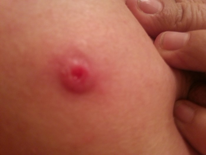 This nest was on the back of my armpit. You can see the core where the mites laid their eggs. This grew to be the size of my thumbnail before drying up (weeks after treatment) and leaving a scar.