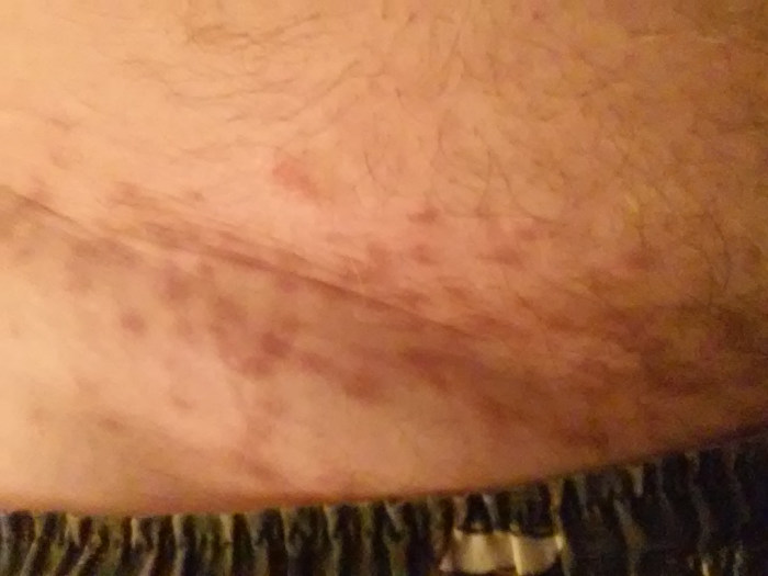 Three months later, signs of the blisters are merely dark spots on the skin. They're not actually scars, but they are still definite reminders of the viciousness of these mighty mites!