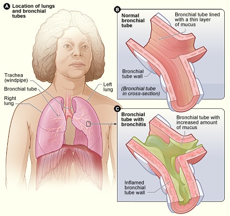 English: Figure A shows the location of the lungs and bronchial tubes in the body. Figure B is an enlarged, detailed view of a normal bronchial tube. Figure C is an enlarged, detailed view of a bronchial tube with bronchitis. The tube is inflamed and