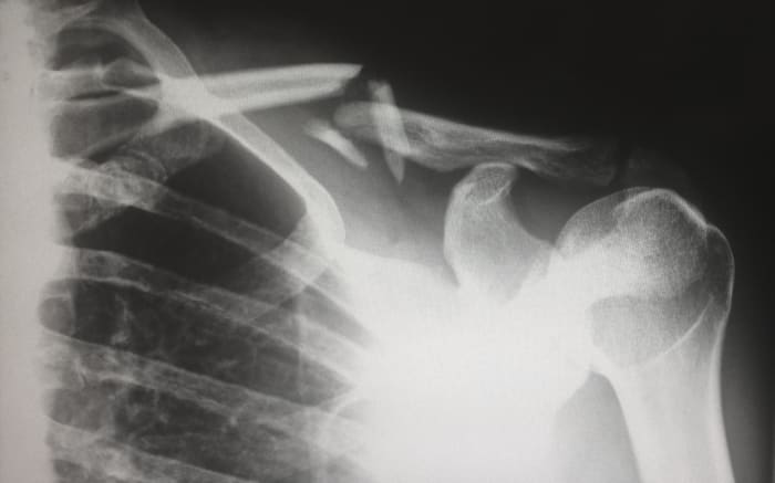 Question: Does PMR Show Up on an X Ray? Answer: PMR doesn't, but inflammation does. Still, doctors have other more accurate ways of checking for inflammation.