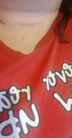 I haven't done as much work on reducing my scar appearance as I should have but I don't feel like I need to. I wear this scar as a badge of honor for the battle I fought. (February 29th, 2020)