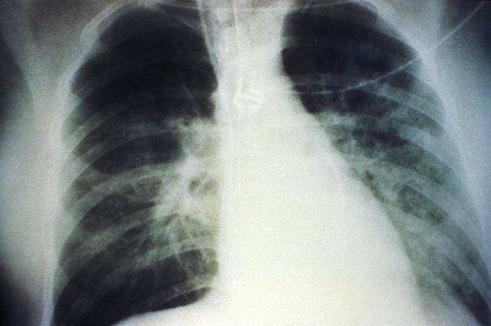This AP chest x-ray reveals the mid-staged bilateral pulmonary effusion due to hantavirus pulmonary syndrome, or HPS.
