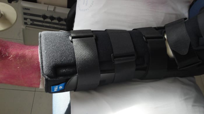 He came back from surgery wearing a big black medical "boot" protecting his broken ankle, with his leg sprayed red up to his thigh.
