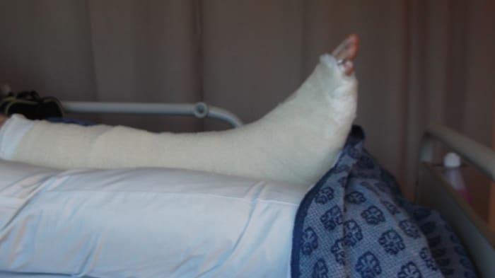 Even in a plaster cast, my husband's broken ankle looked smaller than immediately after his accident when his ankle was swelling.