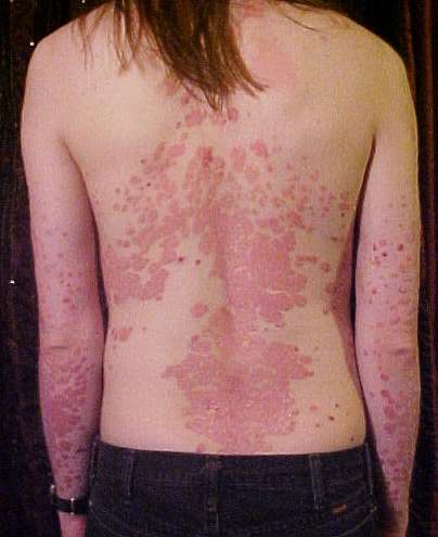 Psoriasis on the back. Very sightly but this can be treated.