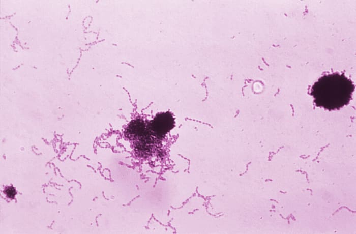 Streptococcus mutans is a common cause of tooth decay.
