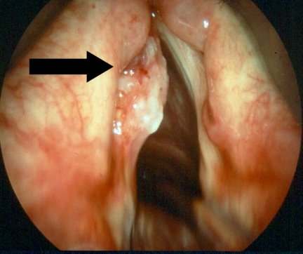 This is a photo of a vocal polyp which can be caused from yeliing, screaming and singing incorrectly.