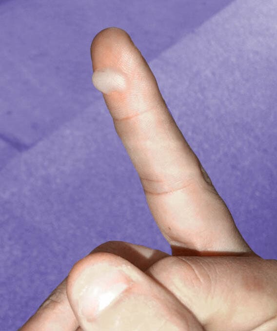 This is one caused by a burn. Even first-degree burns can result in blistering, though it usually won't appear for a couple of days after the trauma occurs.