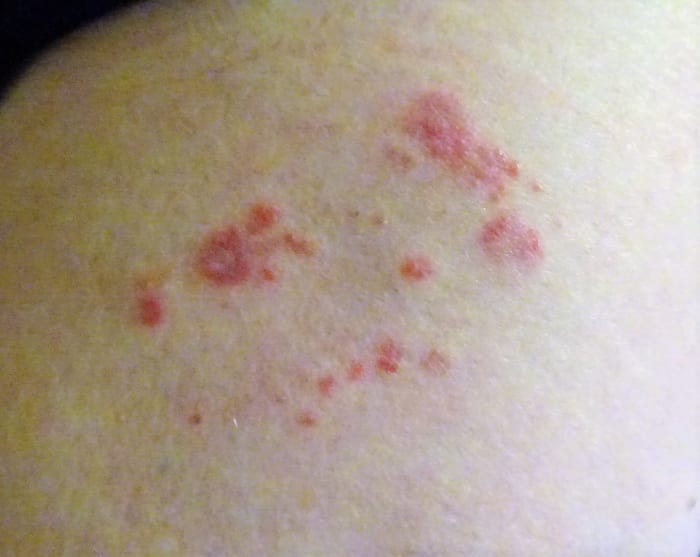Shingles rash looks very much like other herpes rashes. Shingles can be very painful. If you have had chicken pox, you carry the shingles virus.