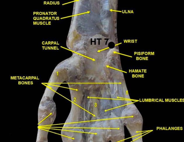 Diagrammatic view of the bones in the hand showing the location of the HT 7 acupressure point for calming the Shen.