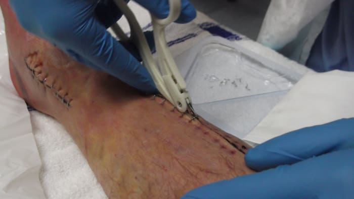 Doctor removing the surgical staples from my husband's leg before I applied a comfrey poultice. Look at the smaller ankle scar before you look at the 'after' photo.