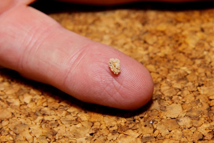 Even a tiny kidney stone can cause extreme pain. Avoid these by changes in your diet or with the assistance of natural herbal supplements.
