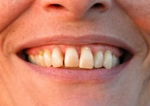 With dedicated effort, periodontal inflammation is decreased, tissues heal, and disease progression is arrested