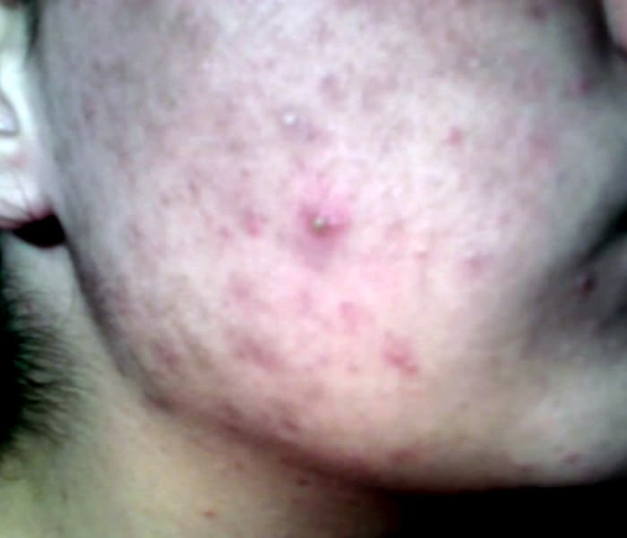 Acne is a common skin condition teenagers. There are many home remedies that you can use to clear up that skin condition.
