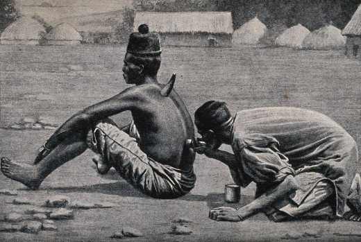 An African medicine man or shaman cupping a patient.