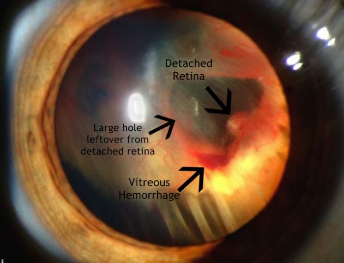 Slit lamp view of a retinal detachment with a vitreous hemorrhage.