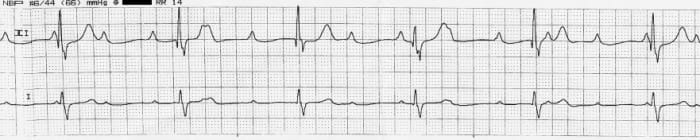 Effects of Anesthesia on the Heart - HealthProAdvice