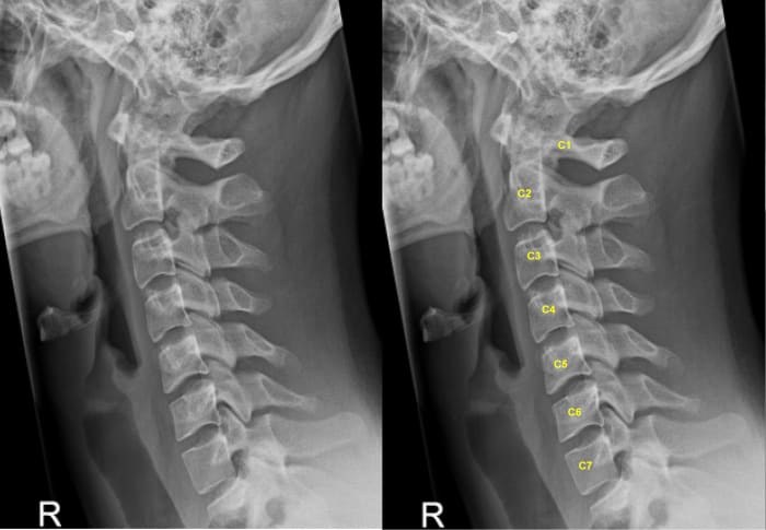 Lateral (from the side) X-ray of the cervical spine showing the number of the vertebrae, C1 to C7, which can be seen by clicking on the photo to enlarge it.