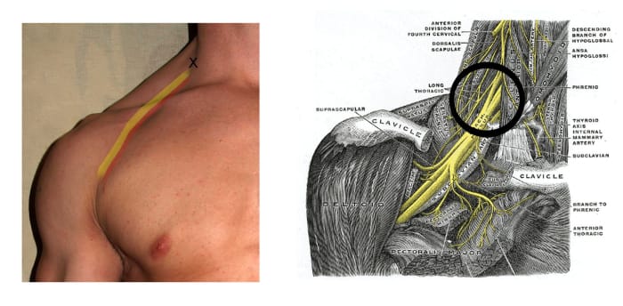 The X in the photo marks the site of injection for an interscalene block, while the diagram shows the target area.