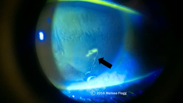 Corneal abrasion in the shape of a piece of lint that was lodged under the patient's contact lens.