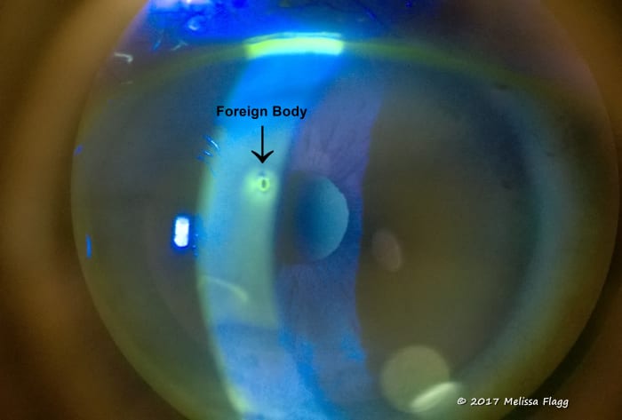 A corneal foreign body. This is a piece of plant material that flew into a patient's eye while she was mowing the lawn. Used with permission.