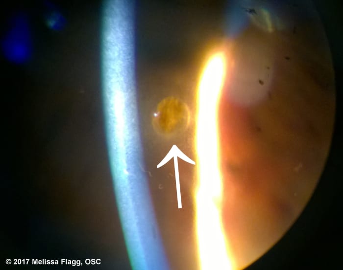 An image of residual rust left behind after the attempted removal of a metallic foreign body by an ER doctor. The FB was left in the eye for about two weeks per the patient before he went to the ER.