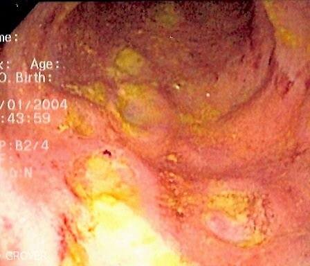 During colonoscopy, ulcers can be seen lining the large intestine in ulcerative colitis. The yellow discoloration represents inflammation and ulceration. The lining should be smooth, uniform and pink.