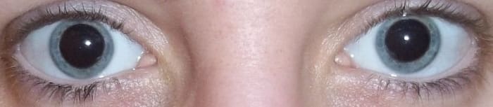 Notice there is more visible iris in this dilated patient than in the photo of the patient dilated with a cycloplegic agent (above).