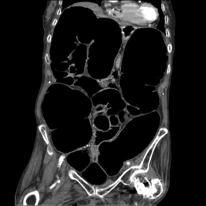 Acute colonic pseudo-obstruction, also called Ogilvie syndrome. The colon is massively dilated.