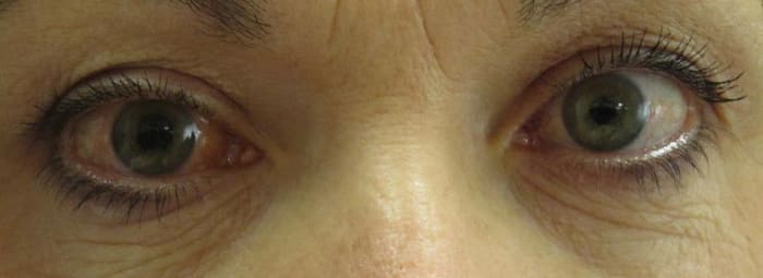 Narrow angle glaucoma in the right eye. Look closely, the right pupil is slightly larger than the left which is typical of an angle closure attack.