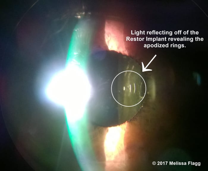 An image of a Restor Intraocular Lens Implant via the slit lamp showing light reflecting off the apodized rings of the implant.