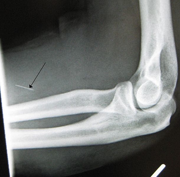 An x-ray showing a needle that has broken off and lodged itself into the tissue of an IV drug user's arm.