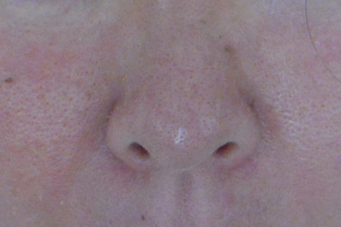 Cosmelan didn't shrink my enlarged pores, but my skin texture is improved. The hyperpigmentation is better, not perfect