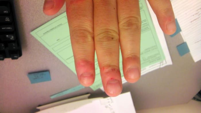 Red, raw, stumpy, bumpy, ouchie, horrible-looking fingernails and fingers! This was over a week after stopping. It takes a long time for fingers to heal up.