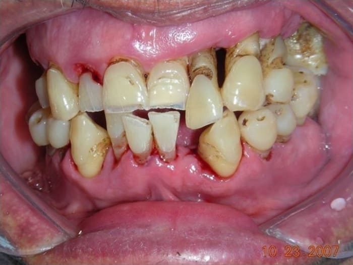 Patient with periodontitis
