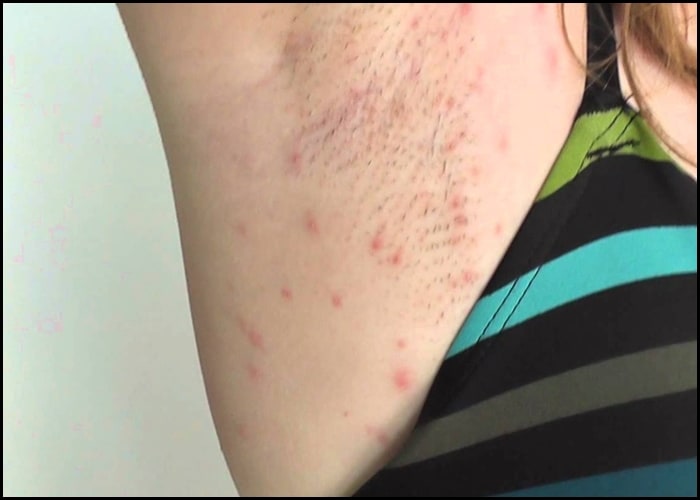 Avoid problems with razor bumps and irritation when shaving your underarms by following the guidelines in the video below.